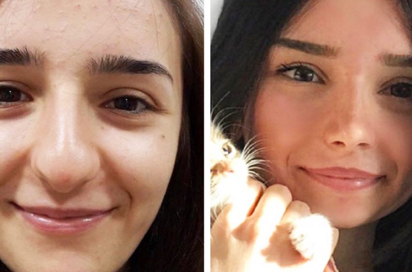  Нос все решает: 5 девушек, которые изменили внешность, сделав ринопластику