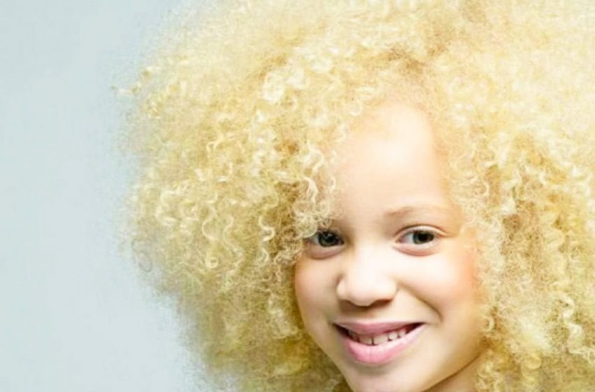  Необычная красота: Как африканская девочка-альбинос сумела превратить свою уникальность в достоинство