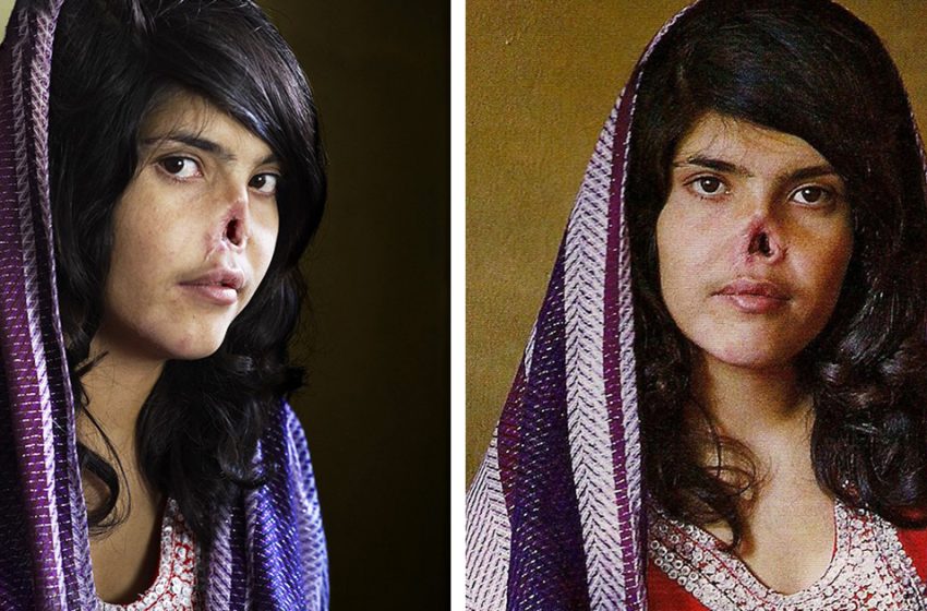  «В 14 лет осталась без носа и ушей по милости мужа»:  как сейчас выглядит женщина