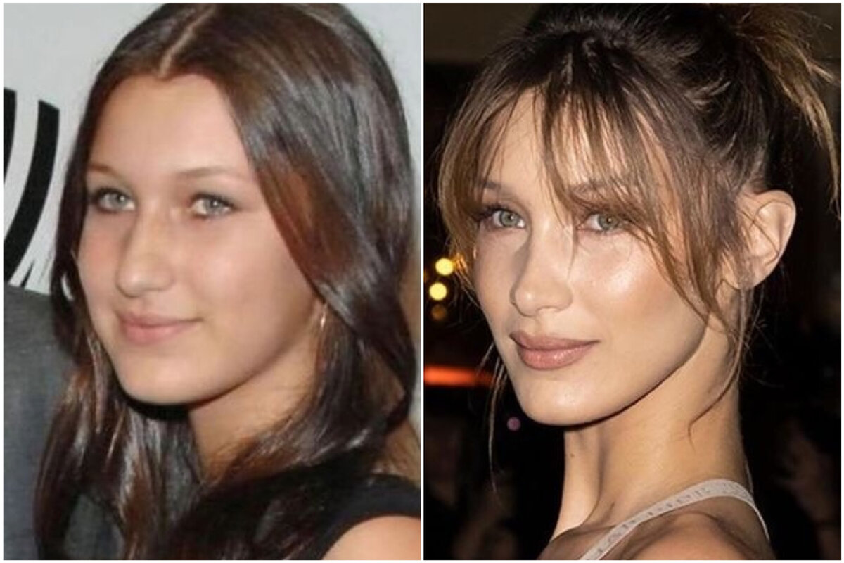 Валерия чекалина фото до и после пластики