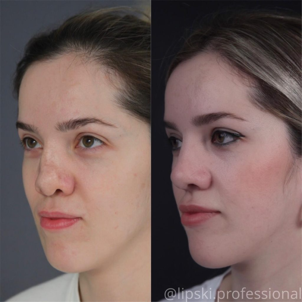 Фото ринопластики до и после нос. Ринопластика Эленшлегер. Пластика носа. Ринопластика до и после.