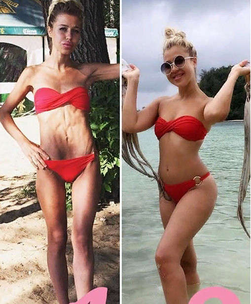 Маша кохно фото до и после анорексии
