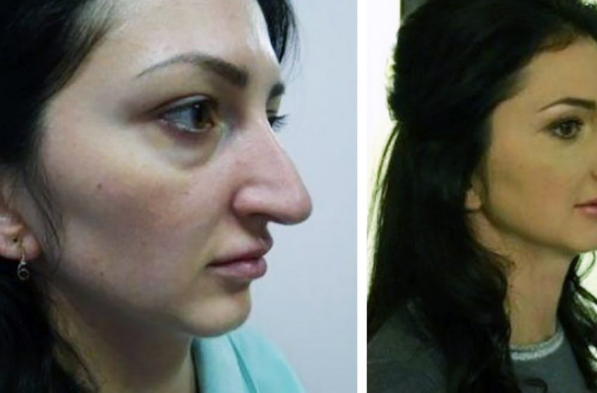  Чудодейственная ринопластика. Как форма носа способна изменить человека?